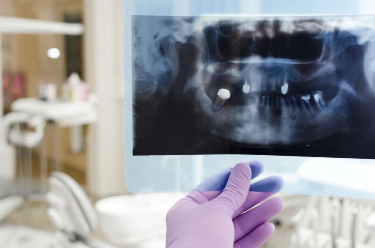 dental implants img